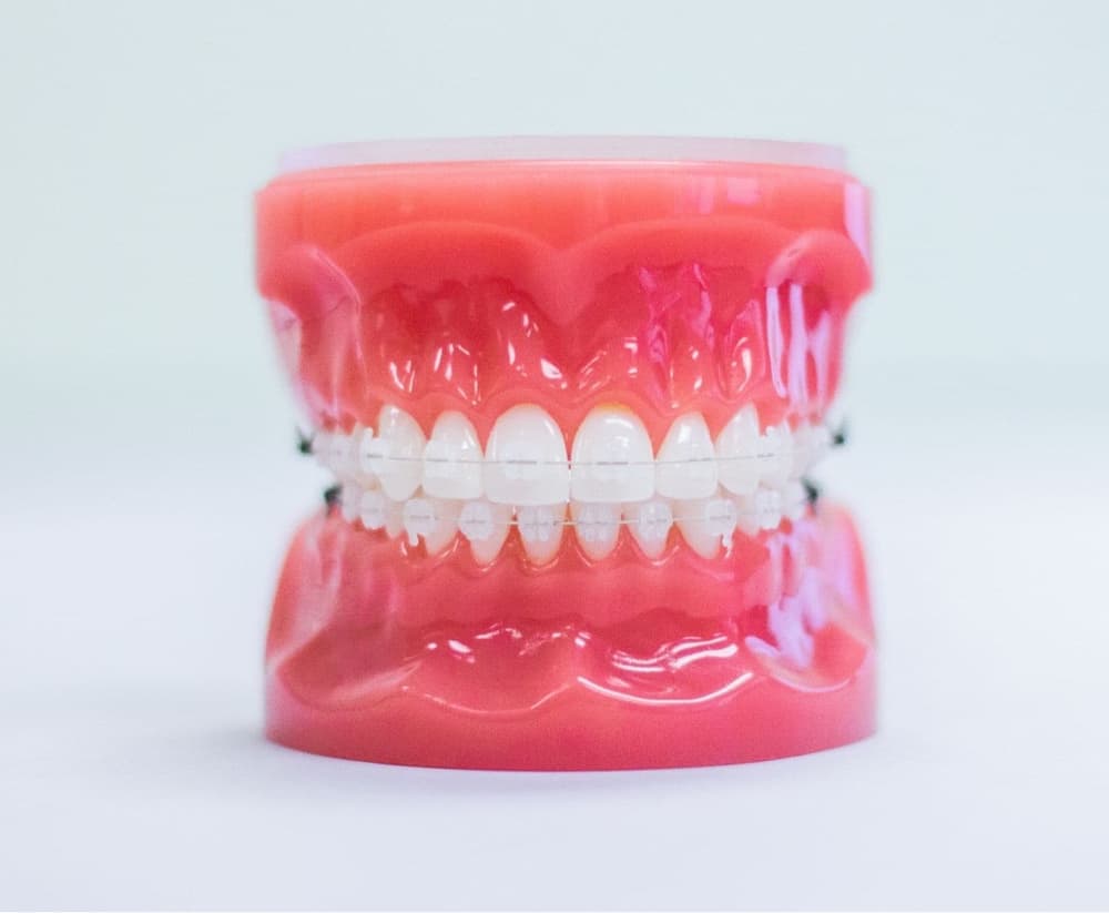 clear braces on plastic model