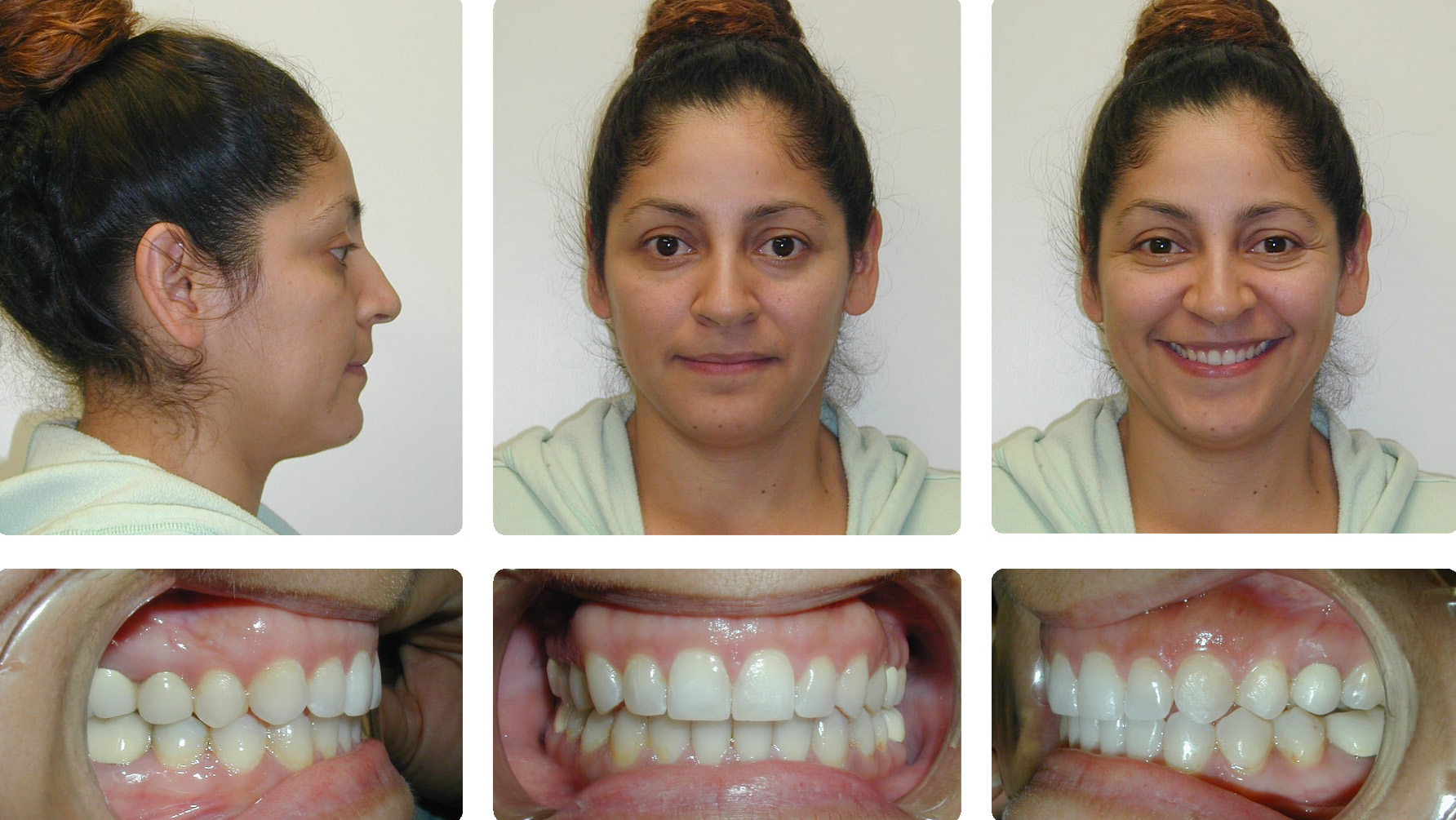 gapped teeth before and after braces gapped teeth before and after braces
