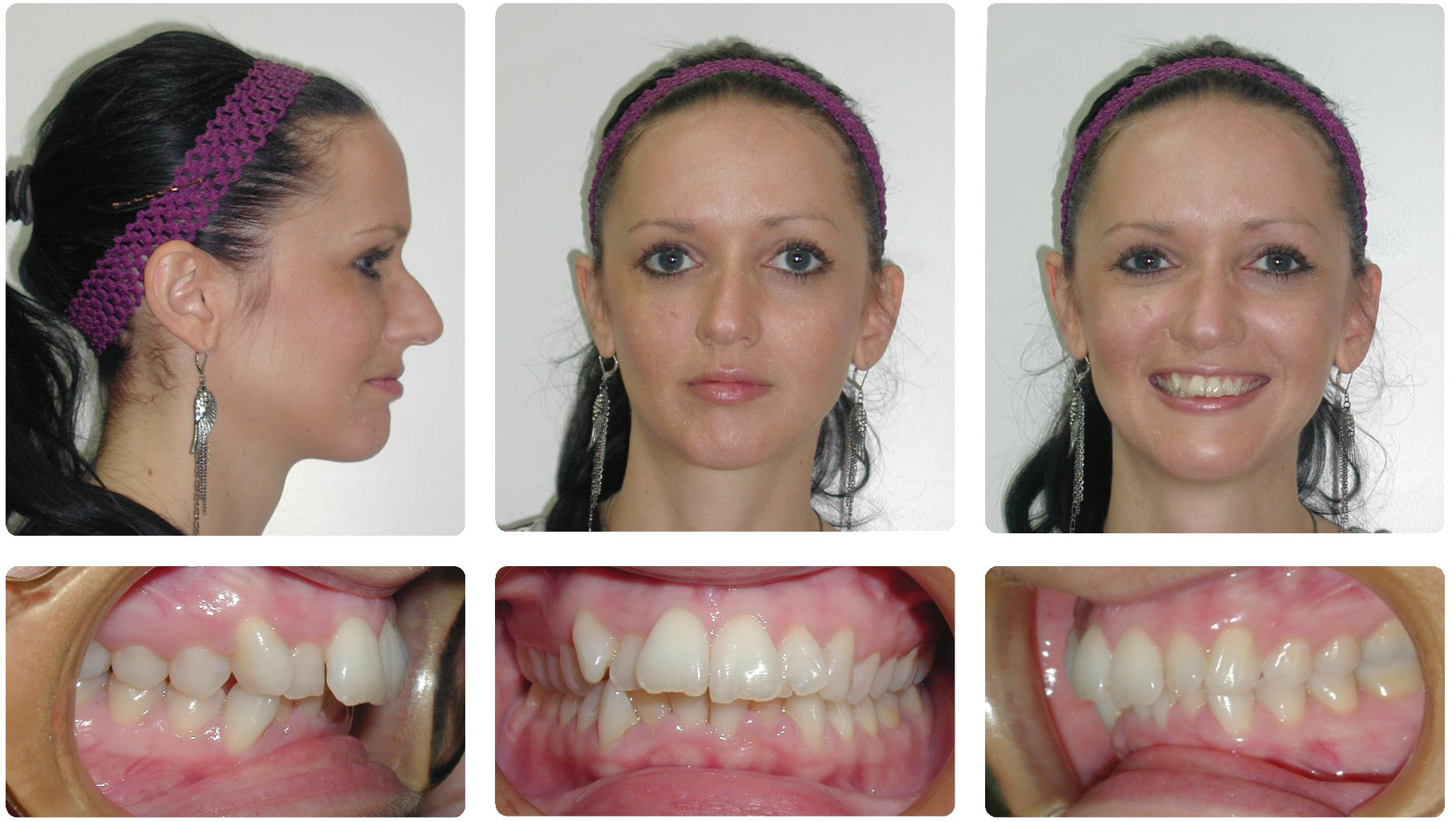 before patient invisalign overbite teeth adult severe crowding smile deep orthodontic crowded bite correct months treatment upper removal orthodontics