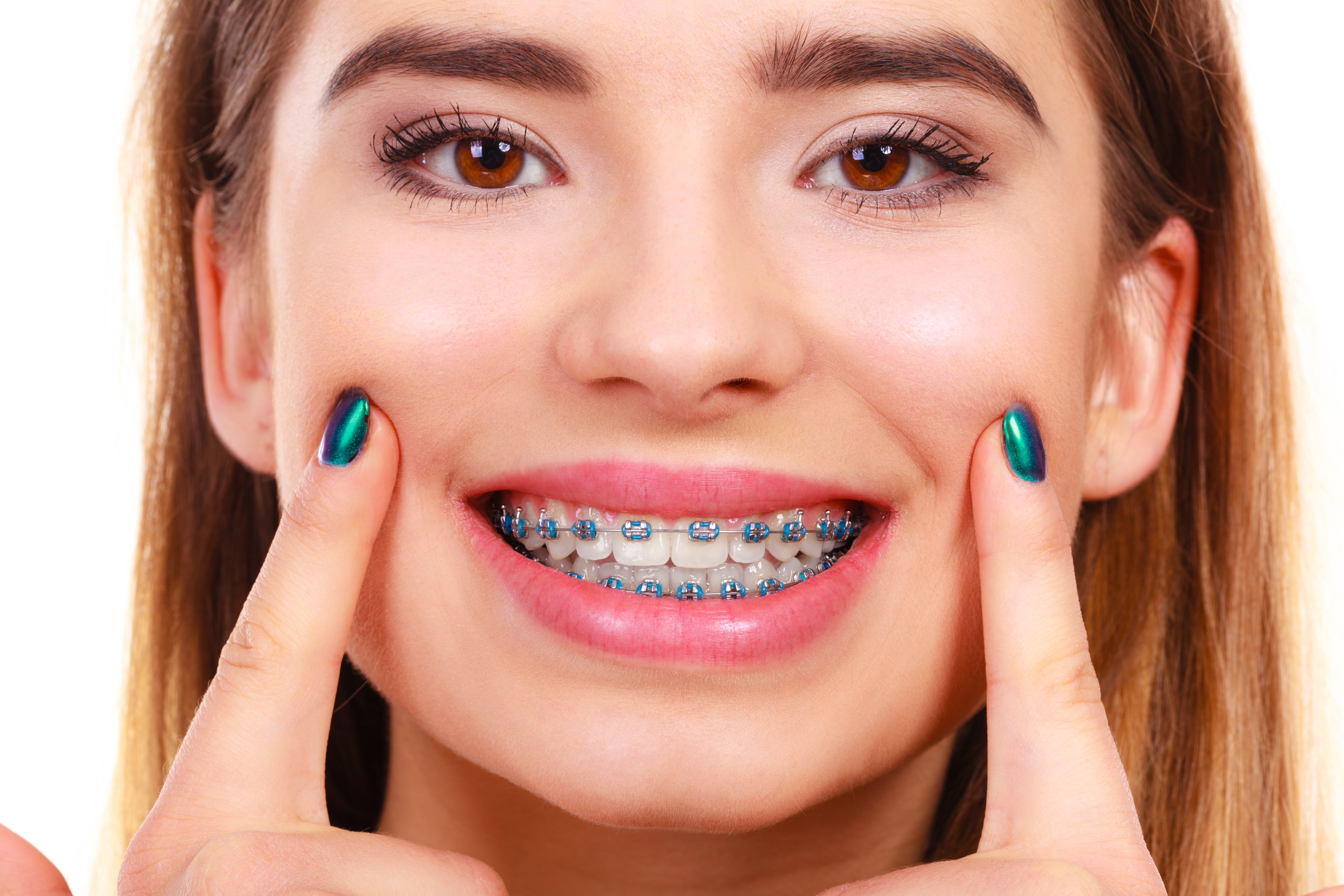 Woman Smiling Showing Teeth With Braces Brodsky Orthodontics 