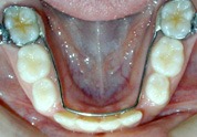 image_arch Lower Lingual Arch