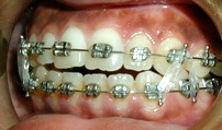image_elastics elastics appliance