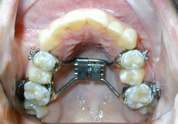 image_expander Palatal Expander