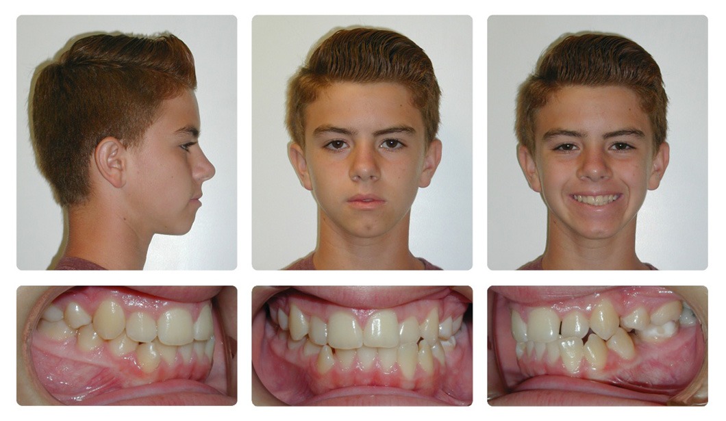 buck teeth before and after braces