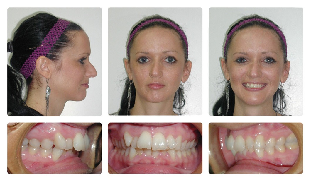 overbite before and after