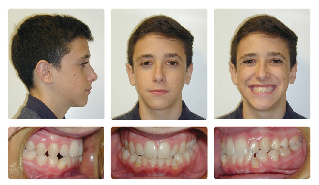 buck teeth before and after braces