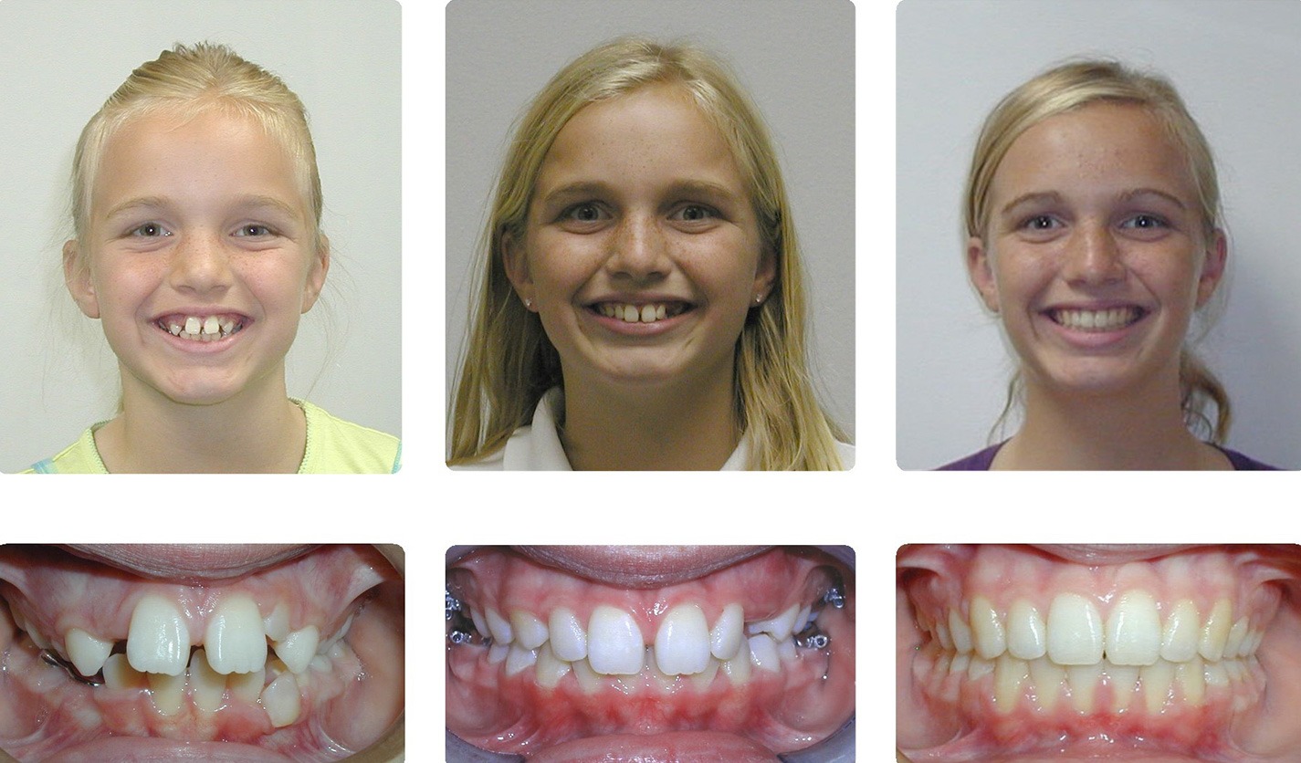 buck teeth before and after braces