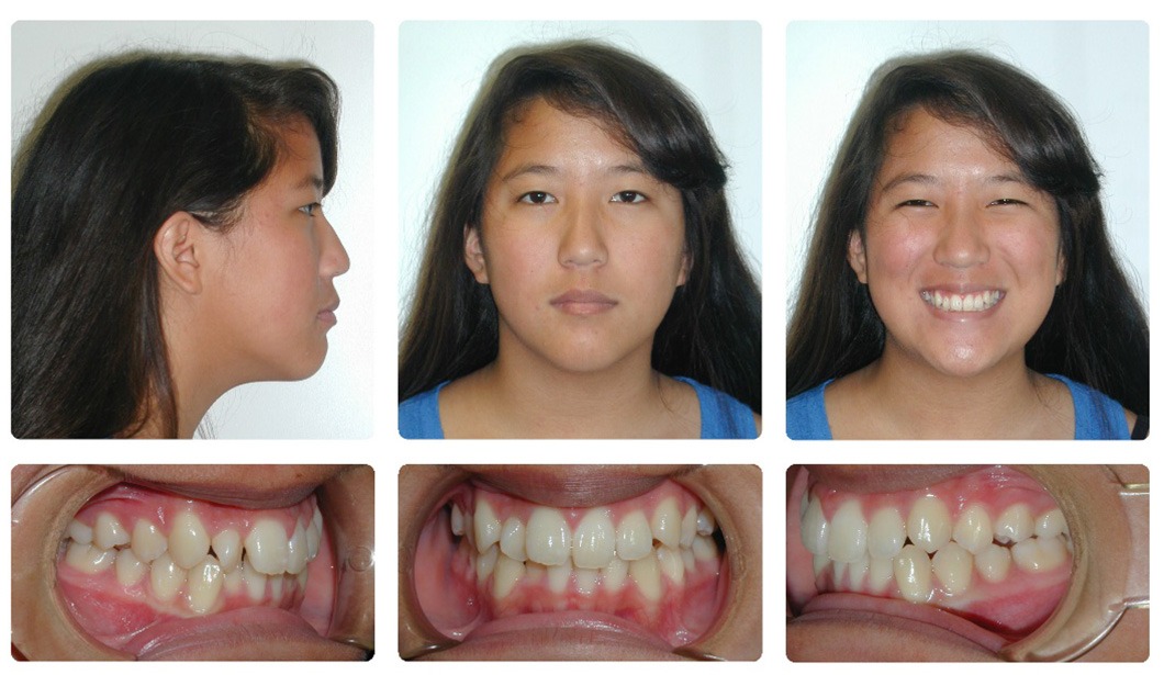 Orthodontic Before and After Photos