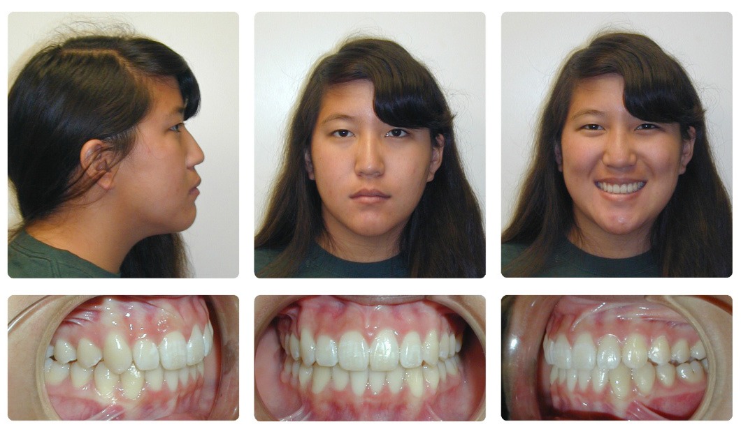 overbite before and after