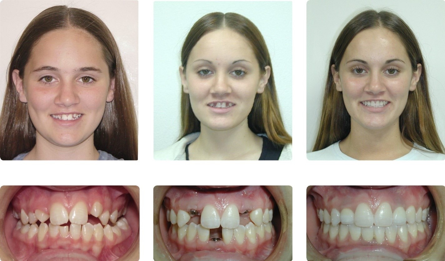 buck teeth before and after braces