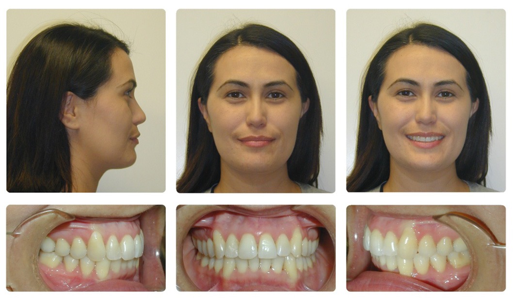 overbite before and after