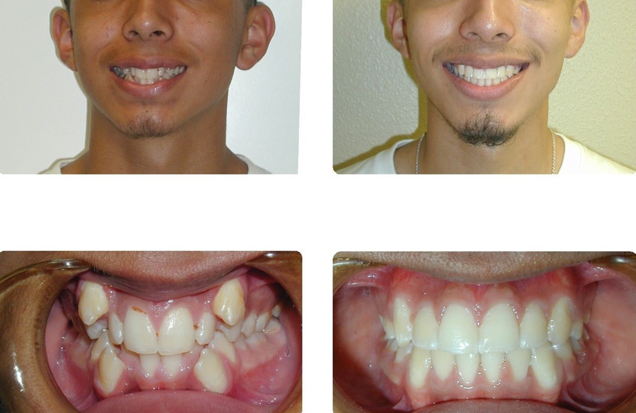 buck teeth before and after braces