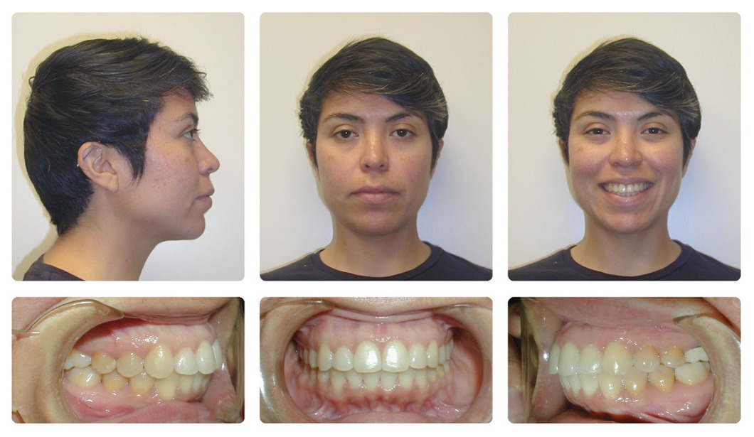 overbite before and after