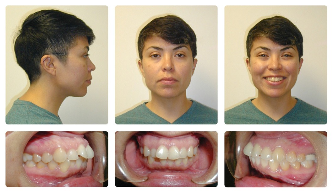 buck teeth before and after braces