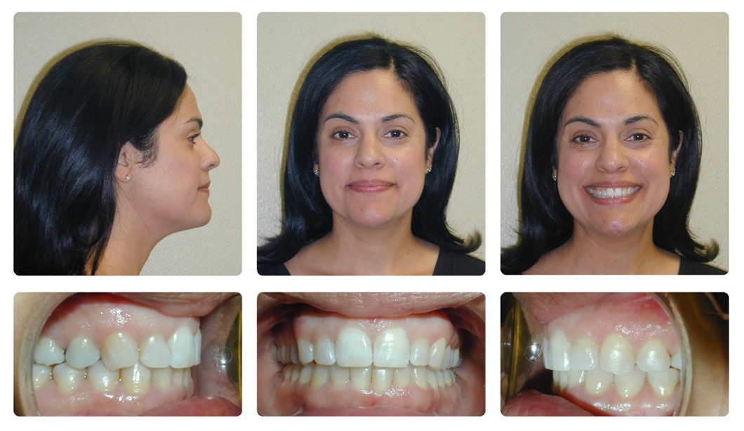 Overbite Correction with Clear Aligners in Thousand Oaks