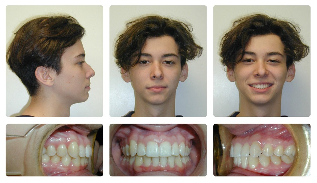 Overbite Before And After Profile