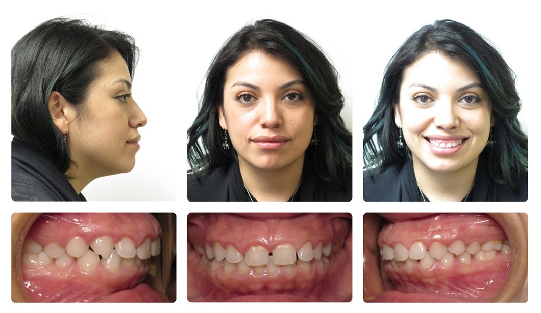 overbite before and after