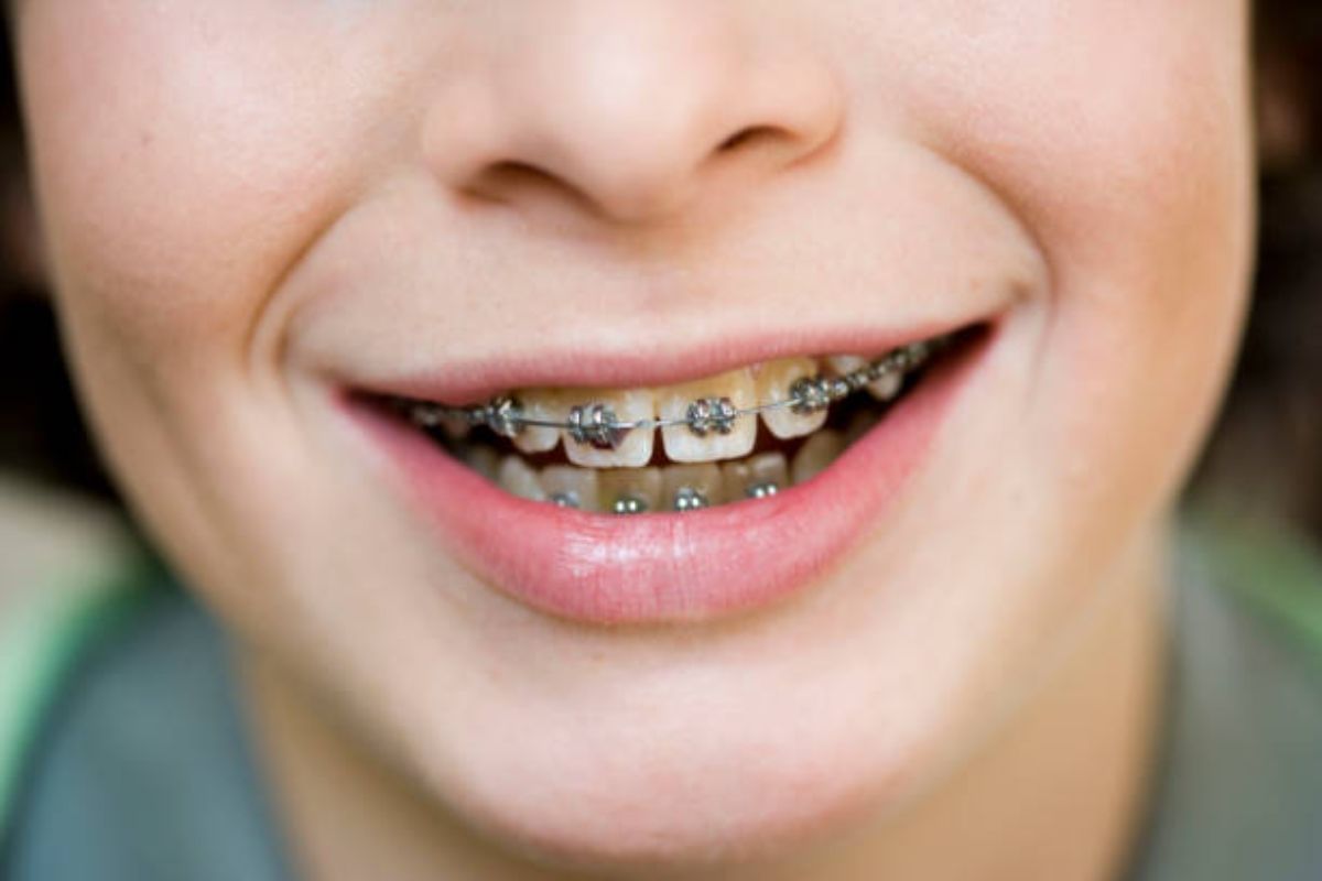 Brodsky - 1 When Do I Get My Braces Off?