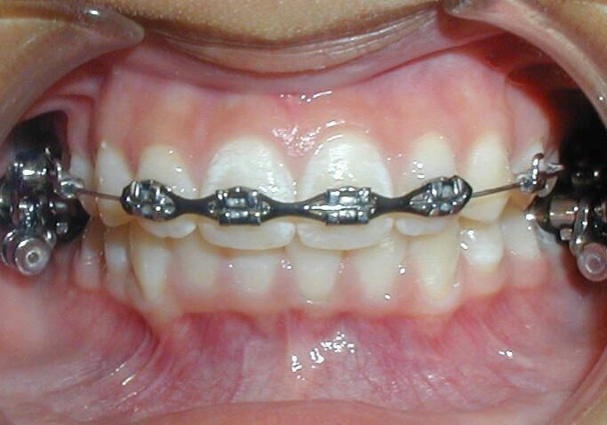 downey invisalign